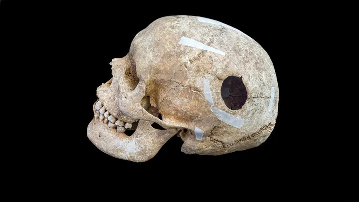 9th-Century Skull with Surgical Opening Suggests Early Brain Operation in Viking-Age Britain