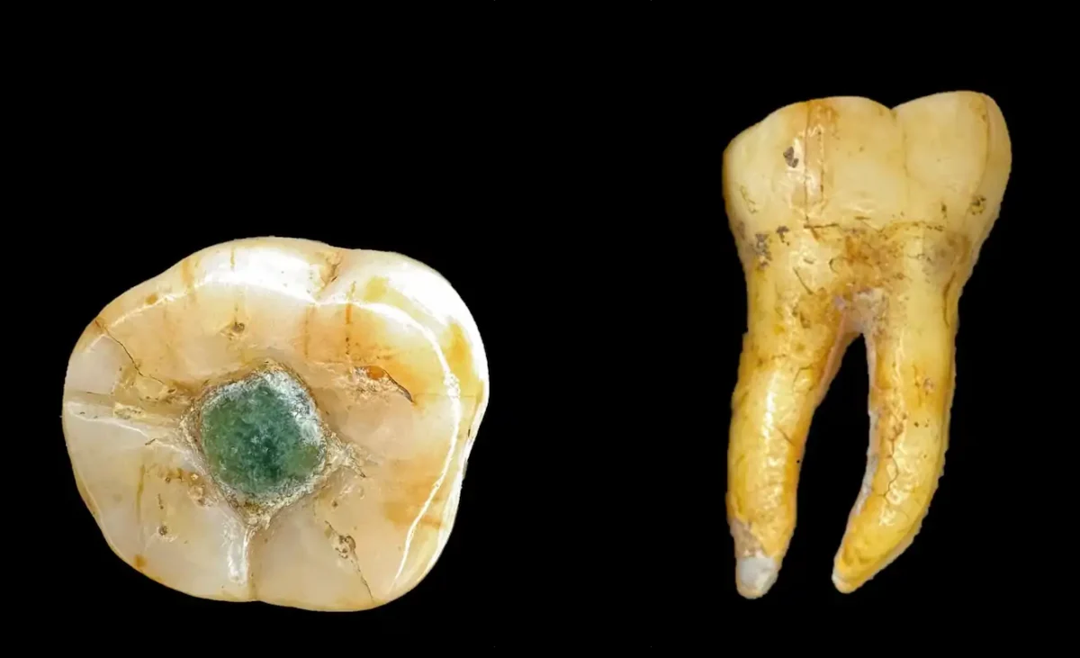 First-Ever Gemstone Filling Found in a Maya Molar — Evidence Shows It Was Done on a Living Person