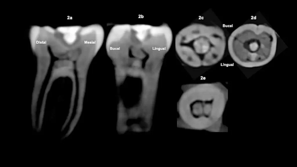 First-Ever Gemstone Filling Found in a Maya Molar — Evidence Shows It Was Done on a Living Person