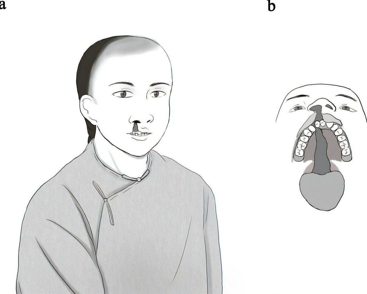 Teen with Cleft Lip Lived and Was Accepted in Qing China, First Archaeological Case Reveals
