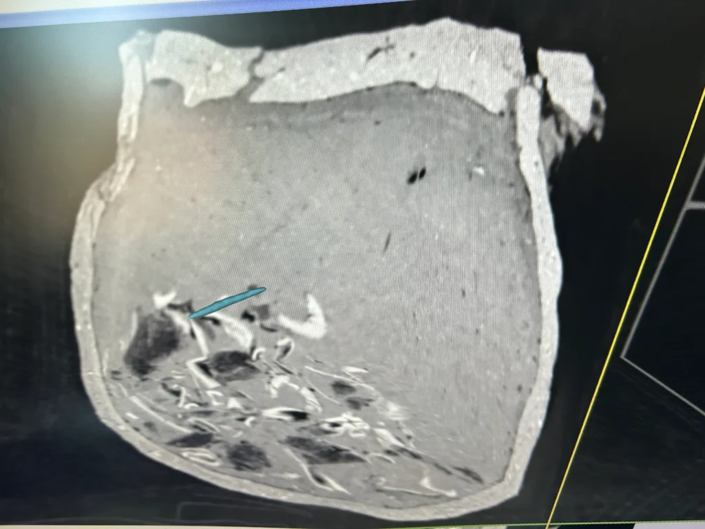 X-ray of a prehistoric burial urn containing cremated bones and a metal object