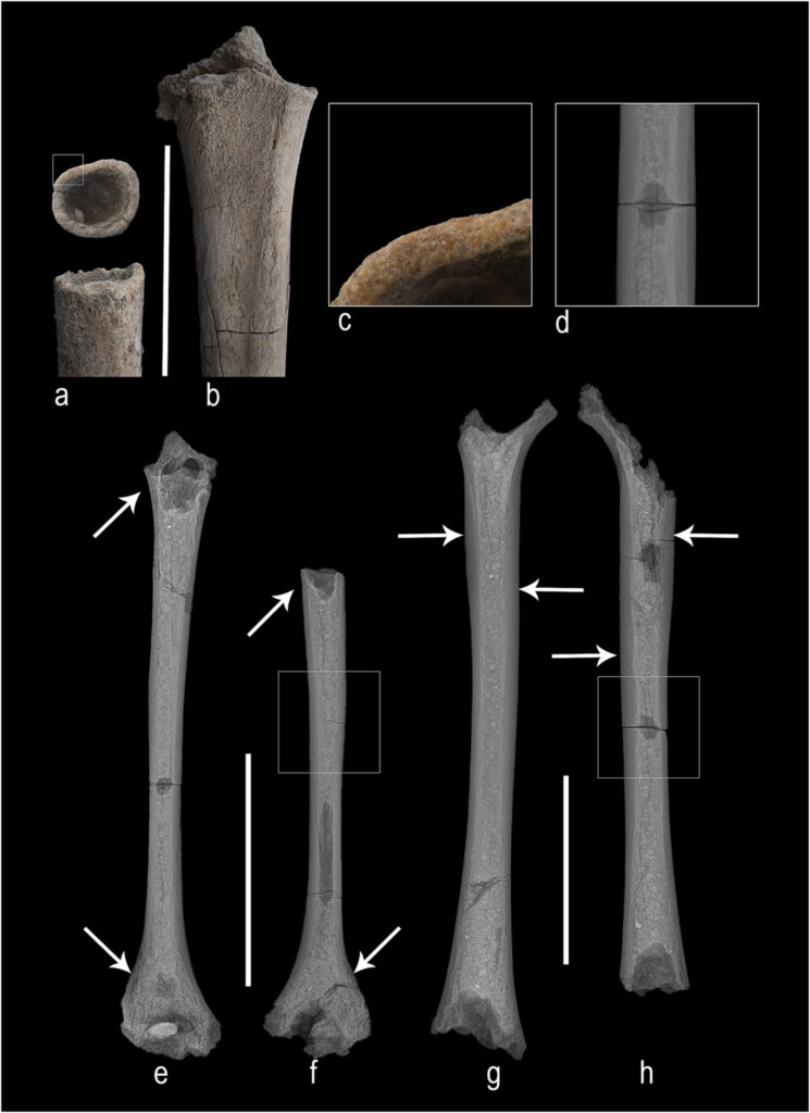 Bones and radiographs showing signs of poor mineralization in the adolescent from Nyaung’gan.