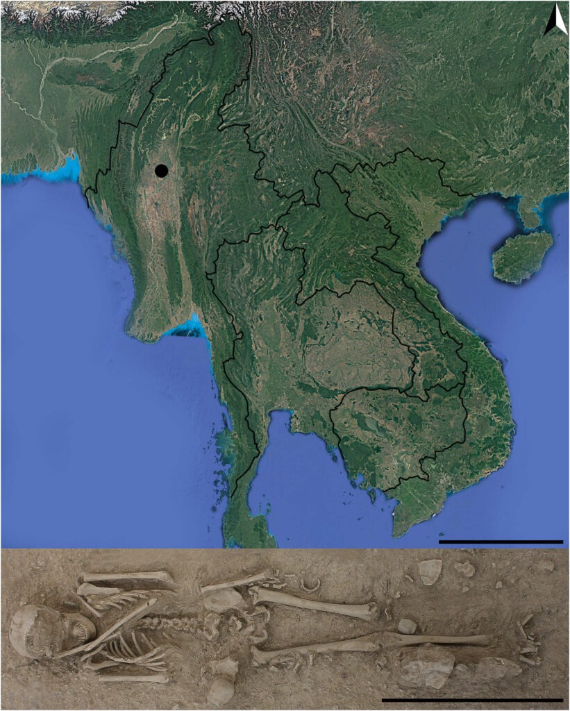 Jaw and tooth changes associated with chronic chewing difficulties in Bronze Age Burial 3b.