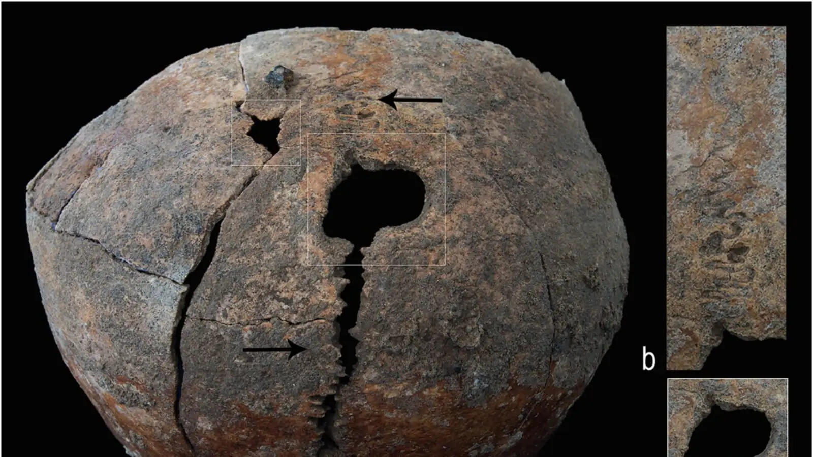 Bronze Age Adolescent in Myanmar May Have Survived Skull Surgery 3,000 Years Ago