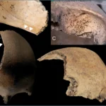 Frontal bone of an Iron Age child from Denmark showing sharp-force trauma.
