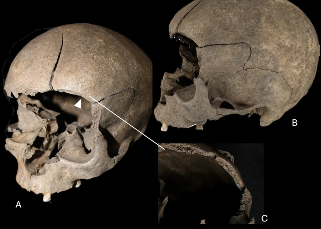 Viking Age female skull from Århus showing a possible sharp-force injury near the left eye.
